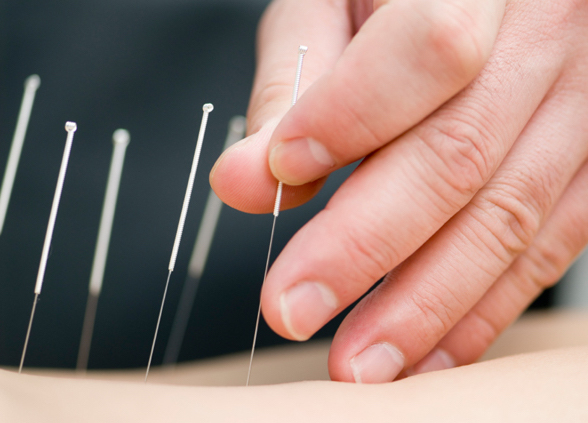 acupuntura medica fisiatria